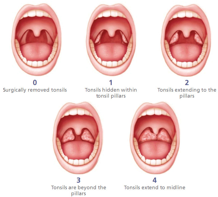 tonsillectomy-for-courtney-by-courtney-stoker-gofundme